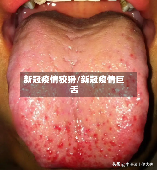 新冠疫情狡猾/新冠疫情巨舌-第2张图片